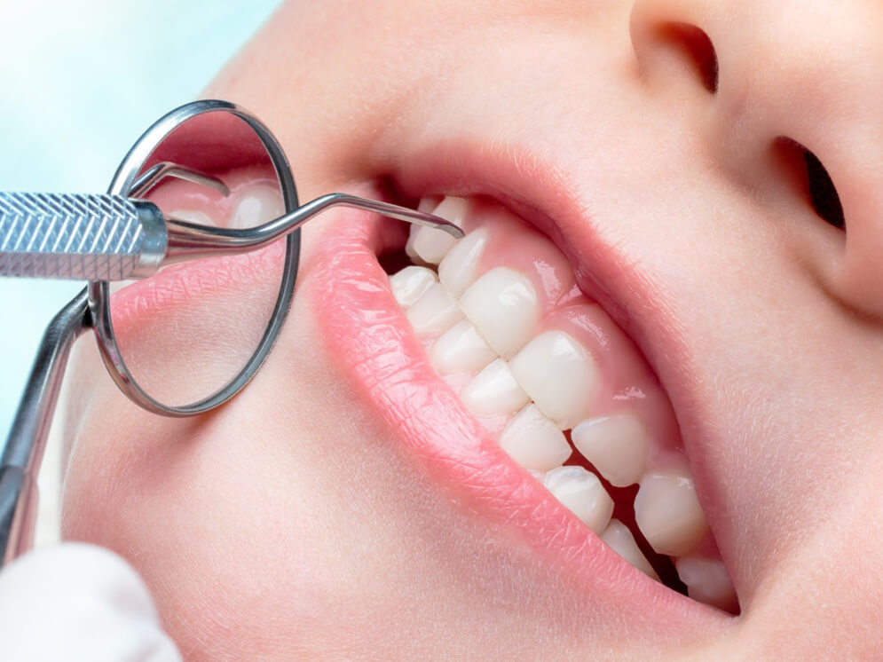lechenie-kariesa-detskih-zubov