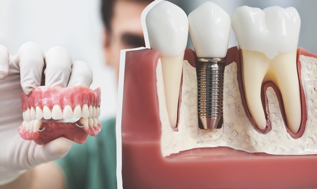 Sovremennaya-implantaciya-zubov