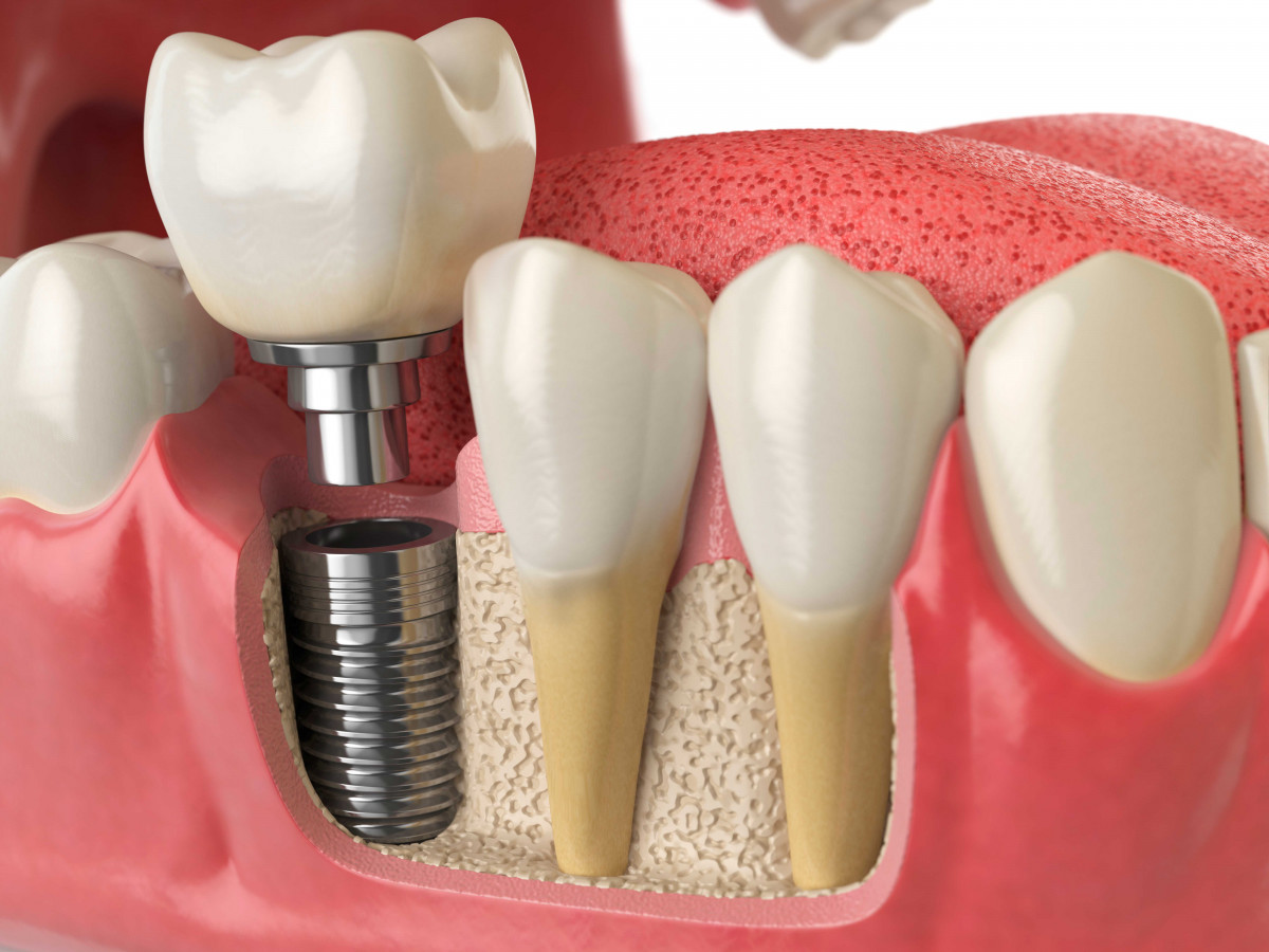 Zubnoj-implant