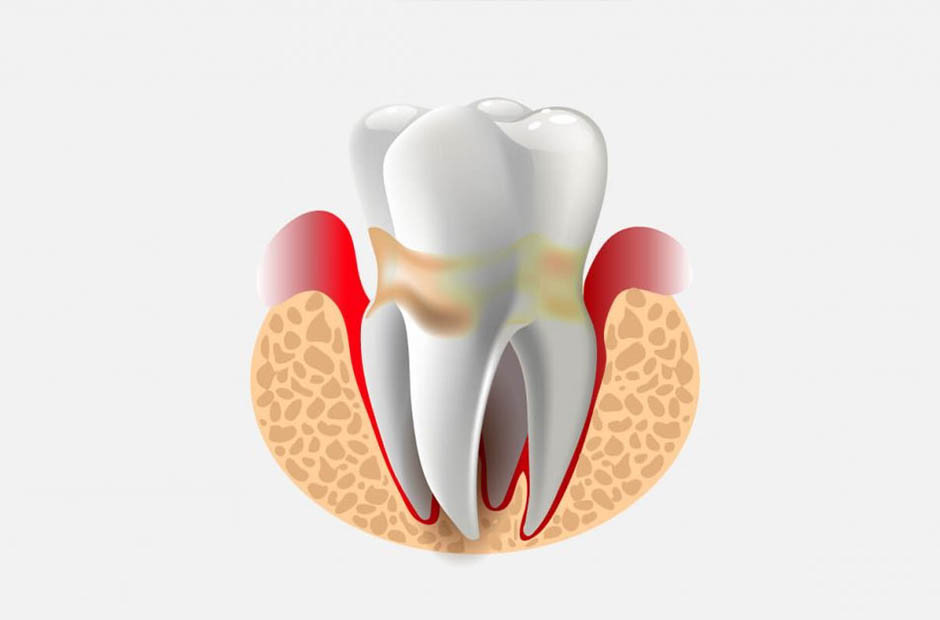 periodontit-desny-lechenie